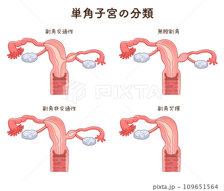 単角子宮の分類・Unicornuate uterus 109651564