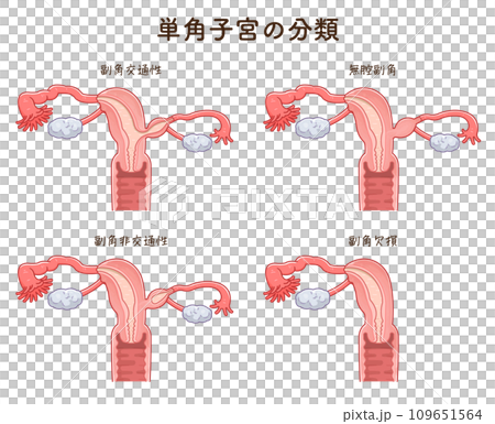 単角子宮の分類・Unicornuate uterus 109651564