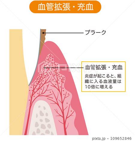 充血した歯茎の断面図　歯科　医療 109652846