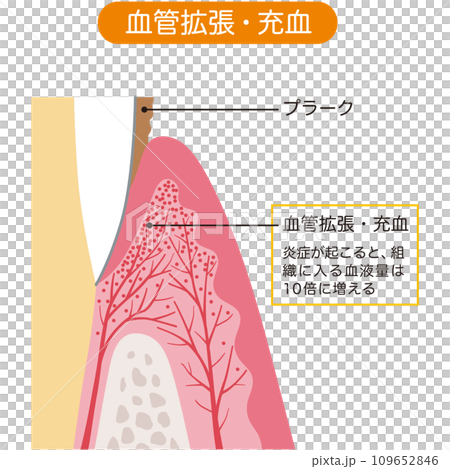 充血した歯茎の断面図　歯科　医療 109652846