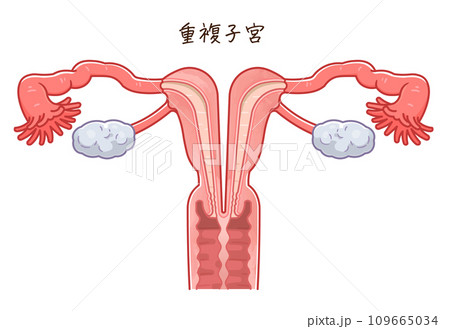 子宮奇形・Uterine malformation 子宮奇形・Uterine malformation 109665034