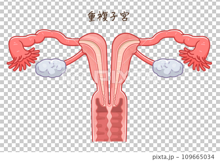 子宮奇形・Uterine malformation 子宮奇形・Uterine malformation 109665034