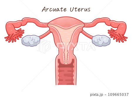 子宮奇形・Uterine malformation 子宮奇形・Uterine malformation 109665037