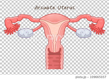 子宮奇形・Uterine malformation 子宮奇形・Uterine malformation 109665037