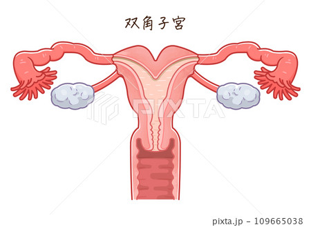 子宮奇形・Uterine malformation 子宮奇形・Uterine malformation 109665038