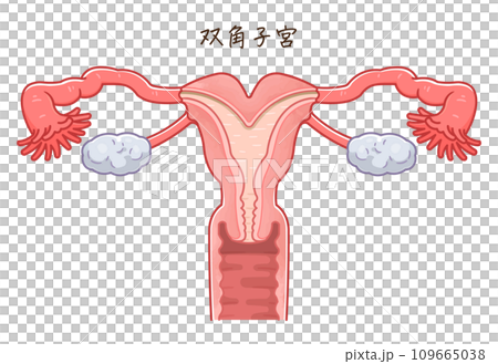 子宮奇形・Uterine malformation 子宮奇形・Uterine malformation 109665038