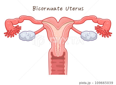 子宮奇形・Uterine malformation 109665039