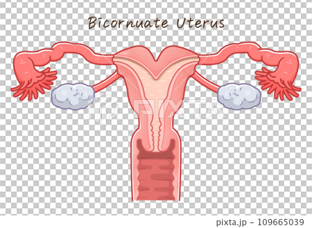 子宮奇形・Uterine malformation 109665039