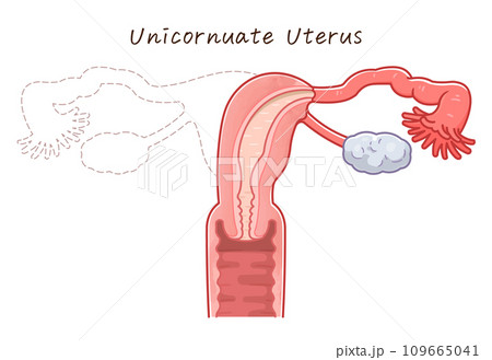 子宮奇形・Uterine malformation 109665041