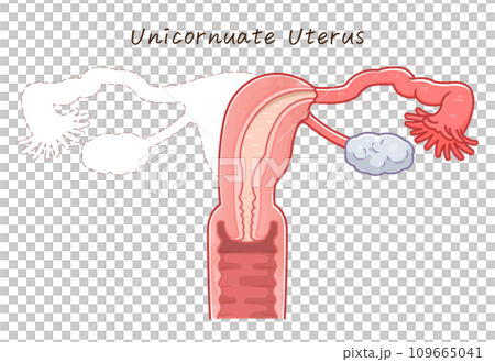 子宮奇形・Uterine malformation 109665041