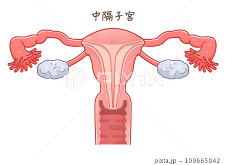 子宮奇形・Uterine malformation 109665042