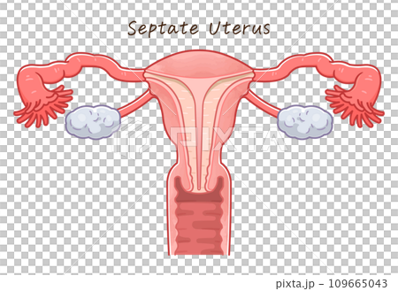 Uterine malformation 109665043