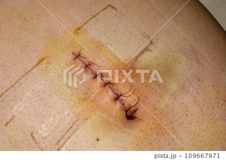 Fresh postoperative suture on the abdomen. Fresh postoperative suture on the abdomen. 109667971