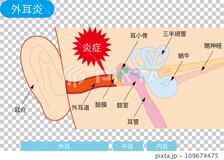 外耳炎の構造図 外耳炎の構造図 109674475