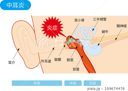 中耳炎の構造図 中耳炎の構造図 109674476