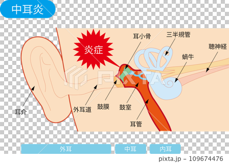 中耳炎の構造図 中耳炎の構造図 109674476