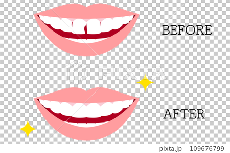 Cosmetic dentistry, before and after direct bonding 109676799