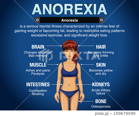 Informative poster of Anorexia eating disorder 109678090