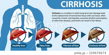 Informative poster of alcoholic liver disease Cirrhosis 109678674