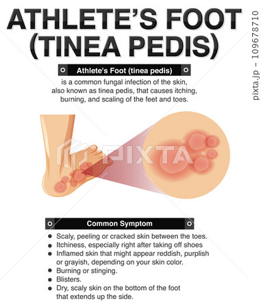 Informative poster of Athlete foot 109678710