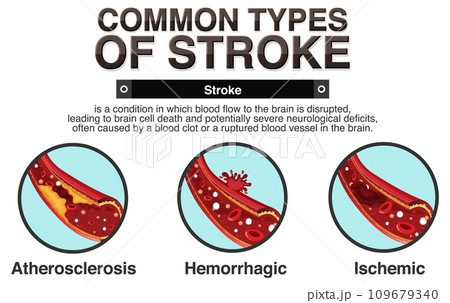 Informative poster of common types of stoke 109679340