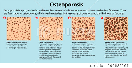 Bone Density and Osteoporosis Vector 109683161