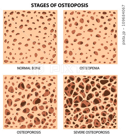 Stages of Osteoposis Vector 109684067