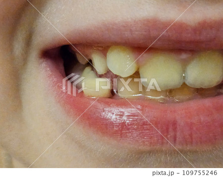 Loss of baby teeth in children and teenagers. Loss of baby teeth in children and teenagers. 109755246