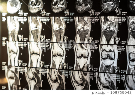 Knee joint x-ray or MRI. Doctor pointed on area of knee joint, where pathology or problem is detected, such fracture, destruction of joint, osteoarthritis. 109759042