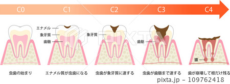 虫歯の進行と症状 109762418