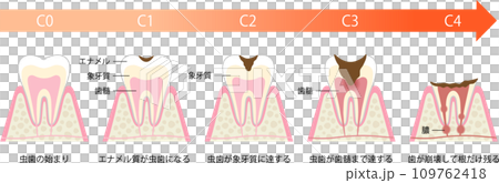 虫歯の進行と症状 109762418