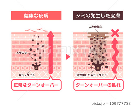 健康な皮膚としみの発生した皮膚のターンオーバー比較イラスト 109777758