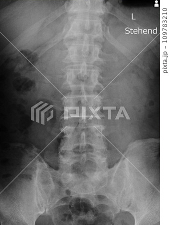x-ray images spine 109783210