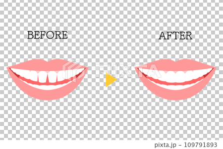 美容牙科，直接黏合前後，有間隙的前牙 109791893