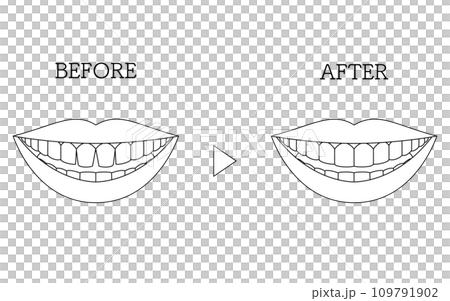 Cosmetic dentistry, before and after direct bonding, front teeth with gaps Cosmetic dentistry, before and after direct bonding, front teeth with gaps 109791902
