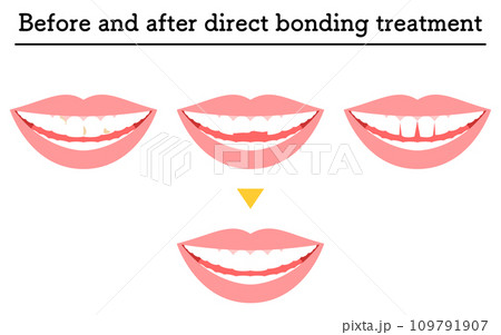 審美歯科:ダイレクトボンディングでの治療、虫歯や欠けた歯、すきっ歯 審美歯科:ダイレクトボンディングでの治療、虫歯や欠けた歯、すきっ歯 109791907