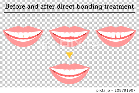審美歯科:ダイレクトボンディングでの治療、虫歯や欠けた歯、すきっ歯 審美歯科:ダイレクトボンディングでの治療、虫歯や欠けた歯、すきっ歯 109791907