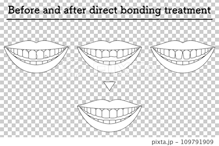 美容牙科：直接黏合治療、蛀牙、牙齒缺損、牙齒間隙 109791909