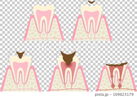 Progression and symptoms of tooth decay 109823179