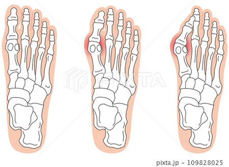 外反母趾 段階 足の骨 骨格図 外反母趾 段階 足の骨 骨格図 109828025