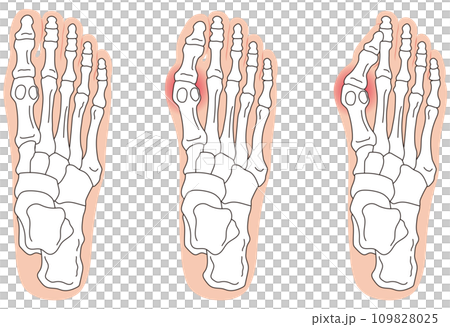 外反母趾 段階 足の骨 骨格図 外反母趾 段階 足の骨 骨格図 109828025
