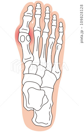 外反母趾　段階　足の骨　骨格図 109828128