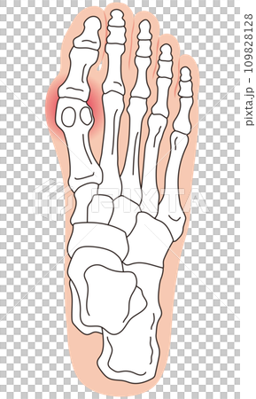 外反母趾　段階　足の骨　骨格図 109828128