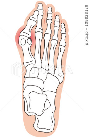 外反母趾　段階　足の骨　骨格図 109828129