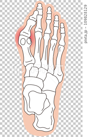 外反母趾　段階　足の骨　骨格図 109828129