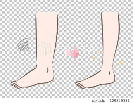太い足・浮腫んだ足とスリムな足のビフォーアフターのイラスト 109829551