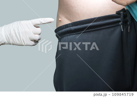 Skin tag or acrochondon or soft fibroma Skin tag or acrochondon or soft fibroma 109845719