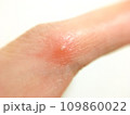 赤い水ぶくれのできものの症状がある指と白い背景のイメージ素材 109860022