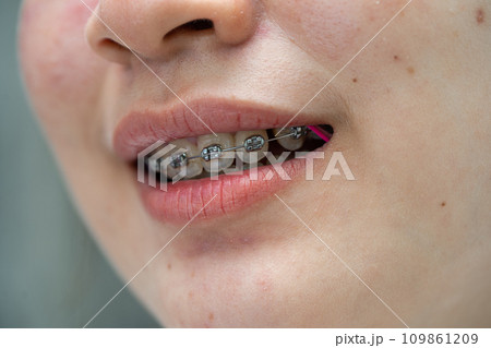 Braces in teenage girl mouth to treat and beauty for increase confidence and good personality. 109861209