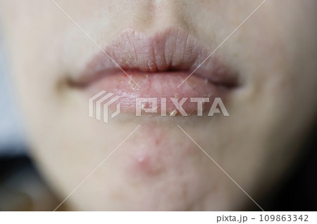 20代女性の乾燥したくちびる　一部出血が見られる 109863342